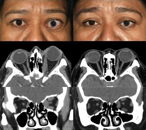 Figure9: Left column: external preoperative and computed tomography of... | Download Scientific ...