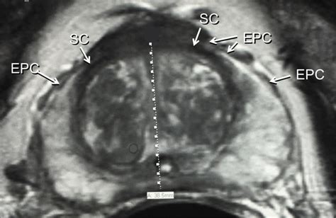 C. Axial T2-weighted MRI. Right and left external prostatic capsule ...