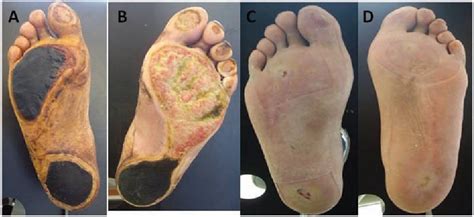 Diabetic Foot Ulcer Infection