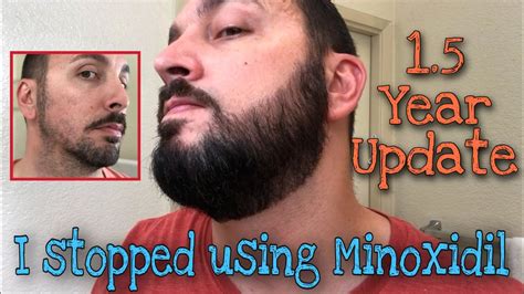 Minoxidil Before And After Beard Result / Kirkland minoxidil before and after beard ...