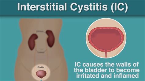 Interstitial Cystitis - Causes, Symptoms and Treatment | My Gynae