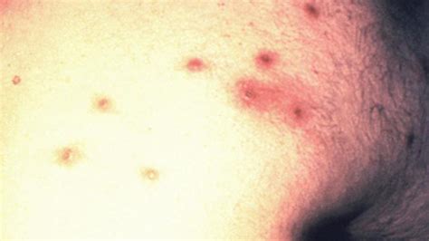 HIV Rash: What Does It Look Like and How Is It Treated?