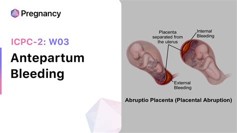 Antepartum Bleeding (ICPC-2: W03)