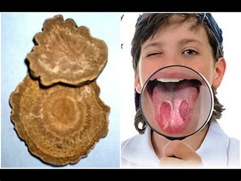 Geographic tongue causes and cures treatment – eciwebeco4