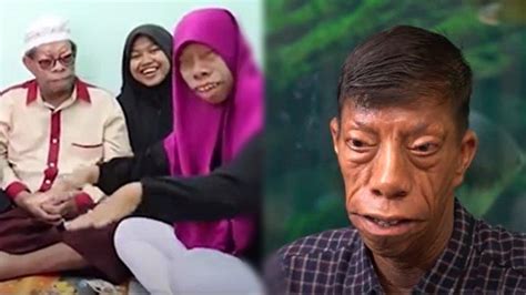 Potret Keluarga Manurung, Viral 5 Anggotanya Idap Sindrom Langka, Kini Jadi Content Creator ...