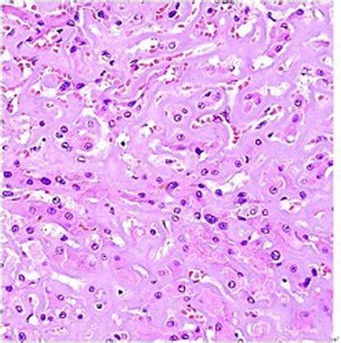 Amyloidosis Histology