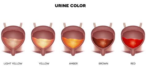 Male Signs of Kidney Stones | STD.GOV Blog