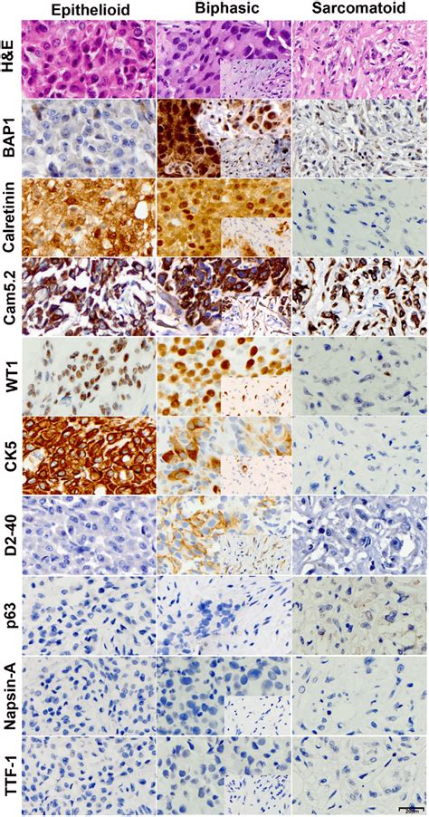 Immunohistochemical characterization of malignant mesotheliomas.... | Download Scientific Diagram