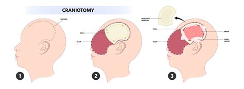 Craniotomy for Tumor - Hart Garner, MD - Minnesota Spinal Neurosurgeon