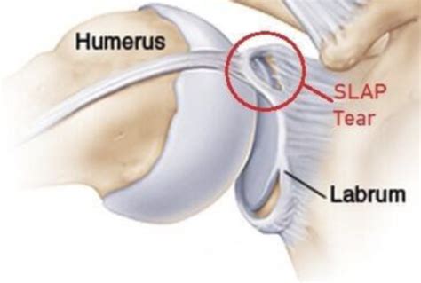 COSM | Superior Labral (or “SLAP”) repair