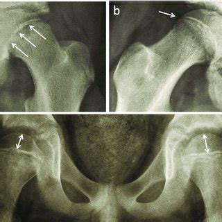 (a) Severe, acute on chronic SCFE in a 15-year-old male patient with ...