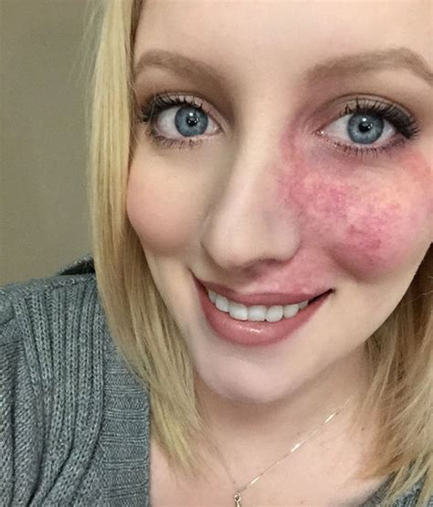 Girl with birthmark shows her face after finding love | Express.co.uk