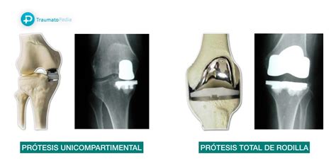 Tipos de prótesis de rodilla -¿Cuál es mejor? - Traumatopedia