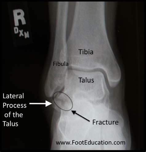 Lateral Talar Process Fractures - FootEducation