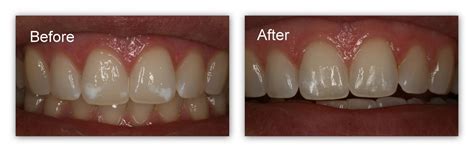 Dr. Jack M. Hosner, D.D.S. -Removal of Superficial Tooth Stains Gallery - Dr. Jack M. Hosner, D ...