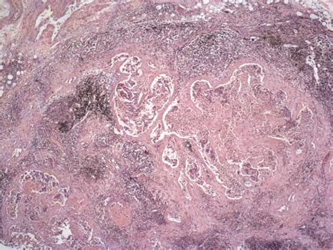 Pulmonary hilar lymph node biopsy. Regional lymphadenopathy... | Download Scientific Diagram