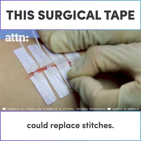 This surgical tape could replace stitches | This innovative surgical ...