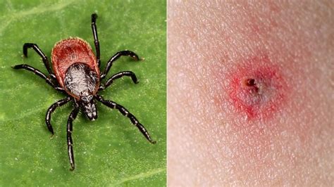 7 Tick Bites that Can Make You Sick | Everyday Health