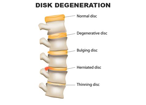 Herniated Disc C4/C5 and C5/C6 Injuries - Fort Worth, TX - Stephens Law Firm, PLLC