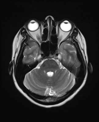 Superficial Siderosis : Importance of Susceptibility MRI Imaging - Blogs