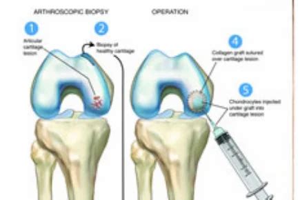 Articular Cartilage Repair Surgery in Jaipur | ID: 19255212888