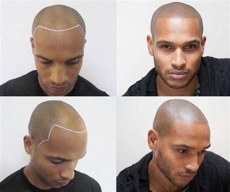 Great Way of Treating Hair Loss in Men | Geniuspharm