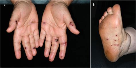 Rat bite fever, a diagnostic challenge: case report and review of 29 ...