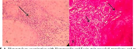 Figure 1 from Chromomycosis Treatment With Combination Of Itraconazole And Terbinafine ...