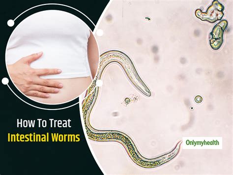 Intestinal Worms: Causes, Symptoms and Prevention tips | OnlyMyHealth