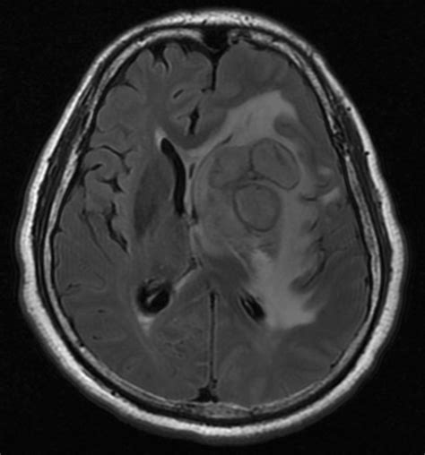 Magnetic resonance imaging of the brain showing a T1 hyperintense, T2... | Download Scientific ...