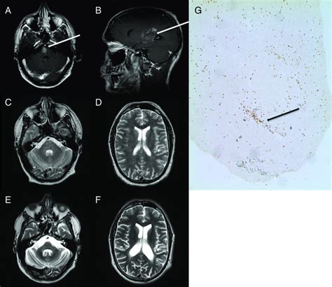 A Coronal gadolinium contrast enhanced T1-weighted MRI reveals a lesion... | Download Scientific ...