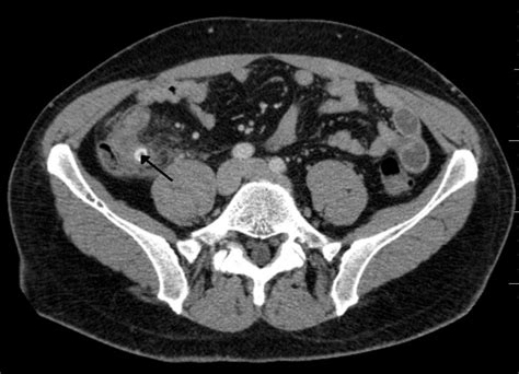 File:X-ray showing fecalith which has caused appendicitis.jpg - WikEM