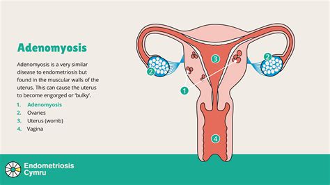 What is adenomyosis? - Endo Cymru