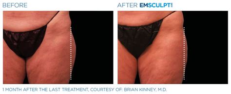 EMSCULPT® NEO for muscle toning - Dr MediSpa Award Winning Clinics