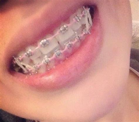 Braces | Brace face, Braces colors, Cute braces