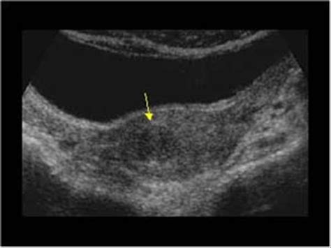 Gynaecology | 3.1 Uterus : Case 3.1.1 Uterine fibroids | Ultrasound Cases