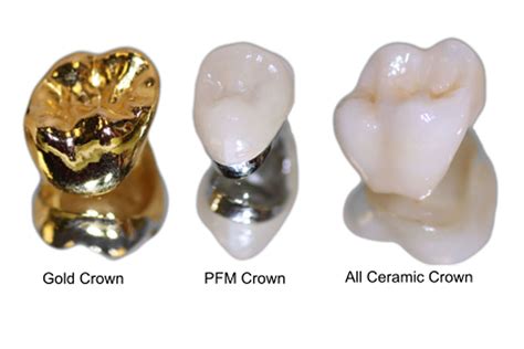 Crowns | DMS Dentistry