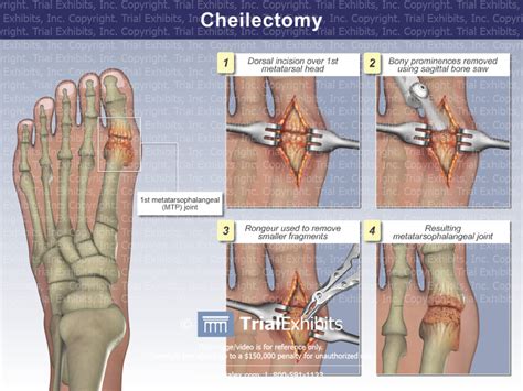 Cheilectomy - TrialQuest Inc.