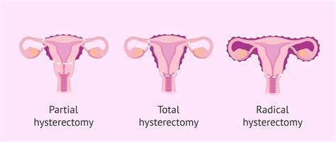 What is a hysterectomy?