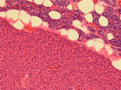 Case 1: Histology showing hypercellular (0.6001g) right inferior... | Download Scientific Diagram