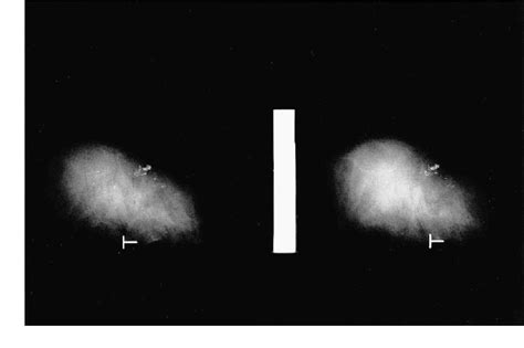 Figure 1 from Breast biopsy for mammographically detected non-palpable ...