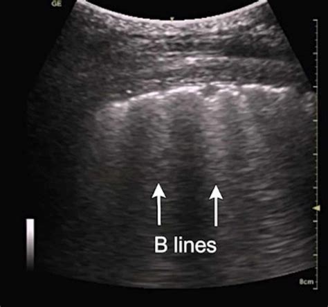 Cureus | Application of Lung Ultrasound in Critical Care Setting: A Review