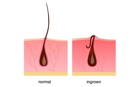 Ingrown Hair: Symptoms, Treatment & Prevention – SkinKraft