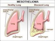 Mesothelium - Assignment Point