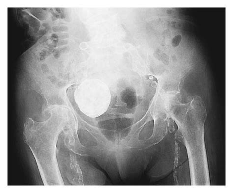 A Calcified Pelvic Mass — NEJM