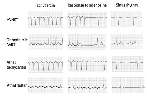 Paroxysmal Atrial Tachycardia Vs Sinus Tachycardia