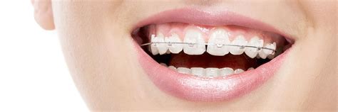 Clear Braces Silver Spring, MD | Invisible Braces