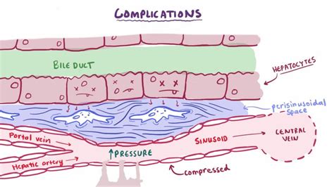 Liver Cirrhosis Pathology