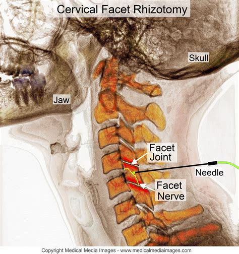 Pin on Health/ Pain Management, Syringomyelia, Chronic Pain, Degenerative Spinal Disease ...