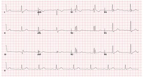 Left Vs Right Bundle Branch Block Ekg | SexiezPix Web Porn